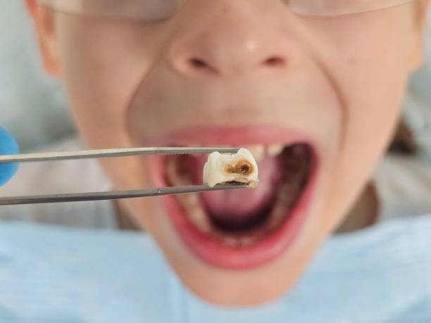 Best Chipped Tooth Repair Near Me  in Dawson, GA